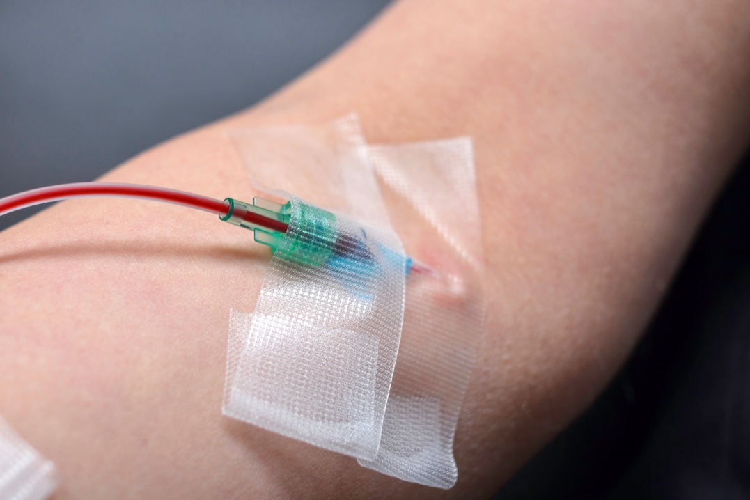 Close-up of 10 pass high dose ozone therapy IV line taped to patients arm.